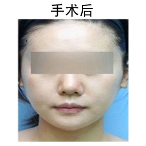 改脸型手术，探寻最佳的选择之地