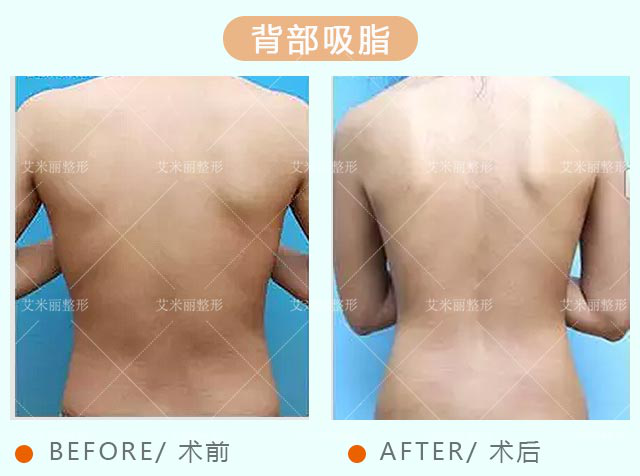 背部抽脂医院，专业塑形，重塑自信