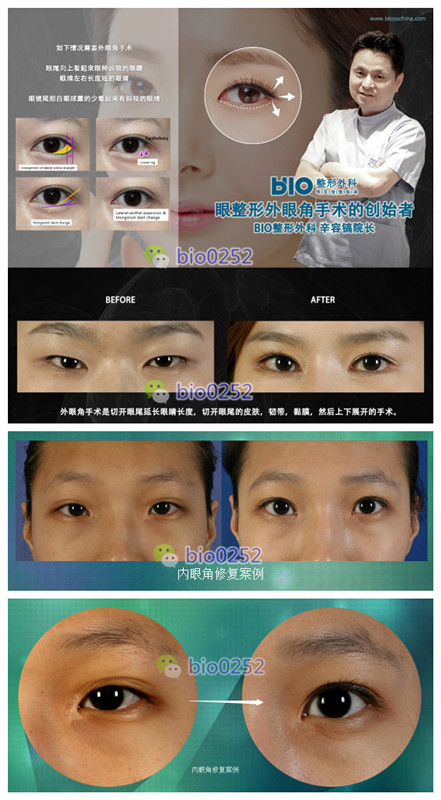 专业治疗眼袋医院——您的眼部美容之选