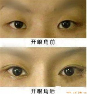 开内眼角医院，专业整形美容的新选择
