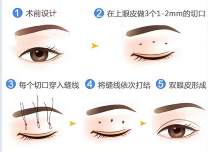杭州割双眼皮的首选之选——炫美网