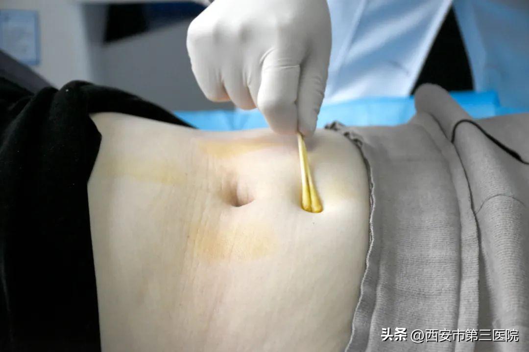 埋线减肥医院，探索现代瘦身新选择