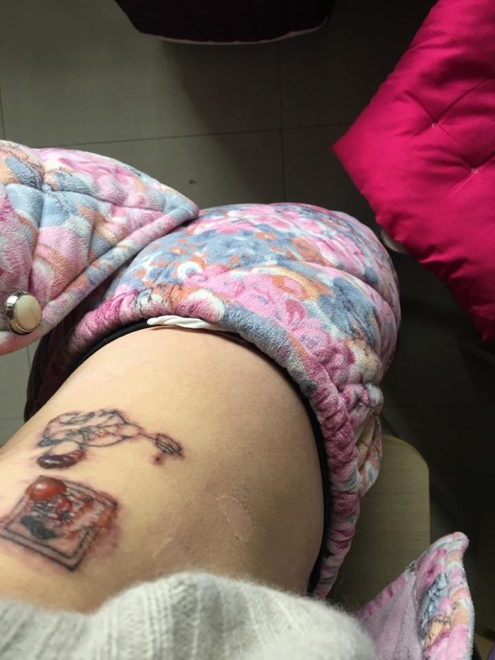 杭州洗纹身的医院推荐与指南