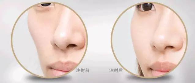 注射玻尿酸，如何选择一家好的医院
