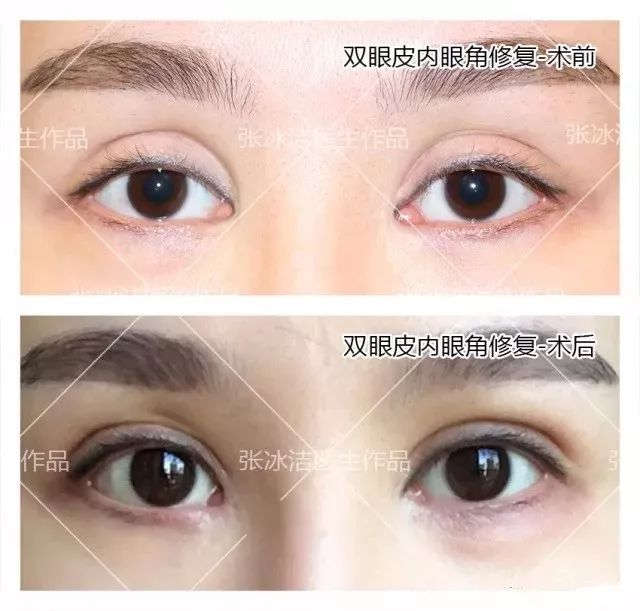 双眼皮修复术，探寻专业双眼皮修复的最佳地点