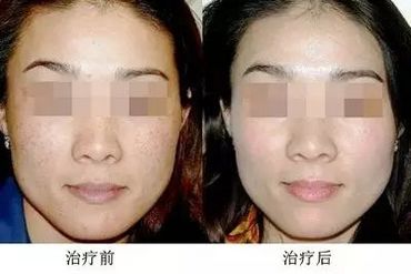 激光祛斑，如何选择最佳的医院
