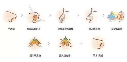 假体隆鼻手术，如何选择最佳的医院
