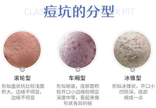 痤疮疤痕医院，专业治疗痤疮疤痕，重塑美丽自信