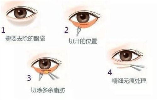 光乳化祛眼袋，重塑眼部魅力，重拾自信光彩