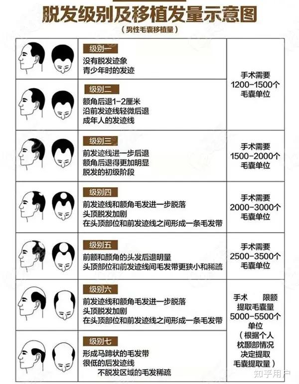 上海植发手术费用详解