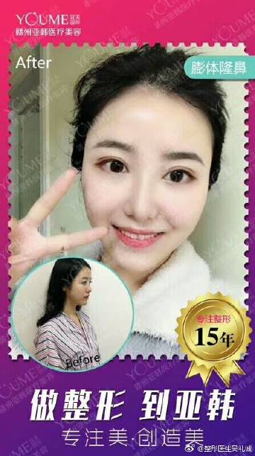 亚韩割双眼皮，美丽的新选择