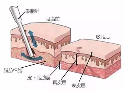抽脂手术，探寻最佳抽脂地点