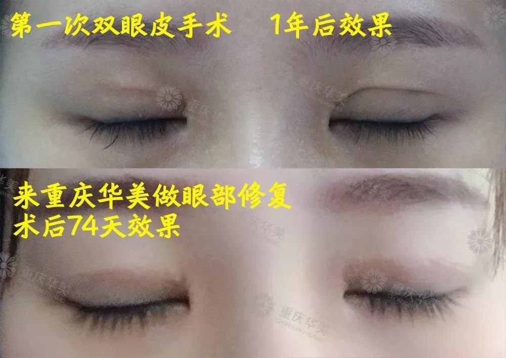重庆开双眼皮，美丽转变的秘诀