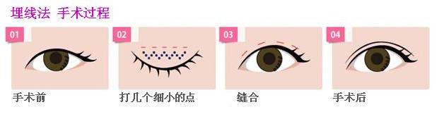 探寻最佳埋线双眼皮手术之道