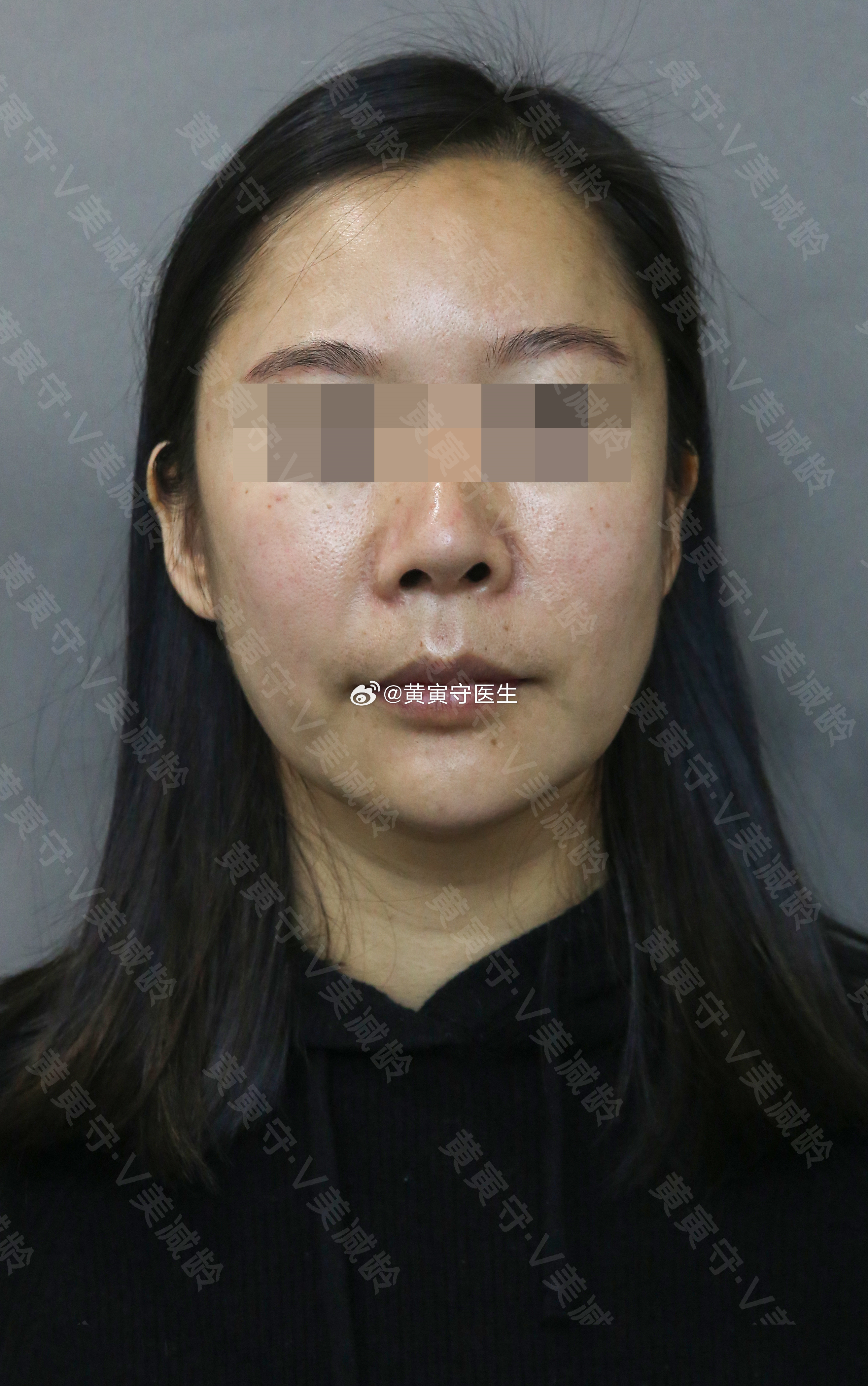 北京面部提升哪里好的全面解析