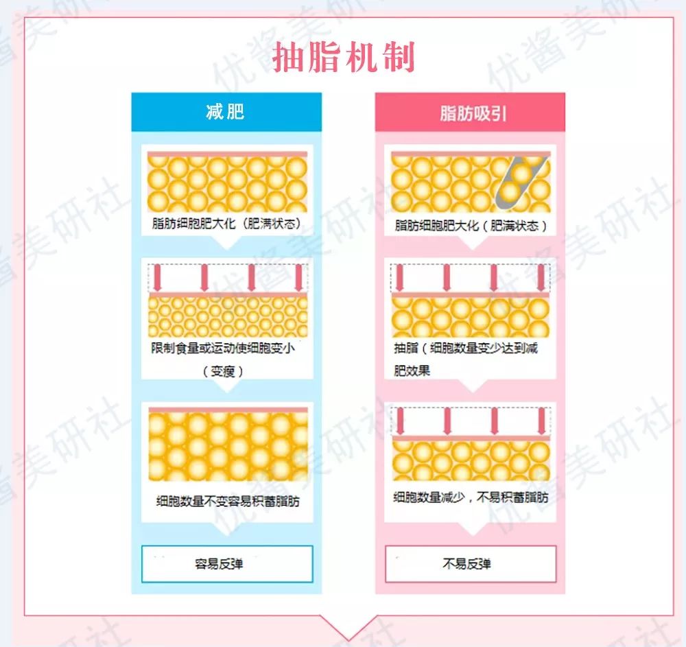 水动力吸脂价格，全面解析费用因素与选择策略