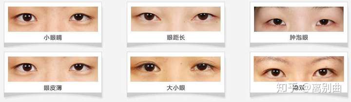 北京开双眼皮手术费用详解