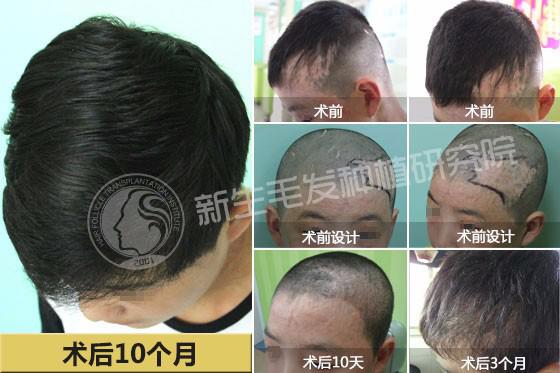 杭州植发，重塑自信，焕发新生