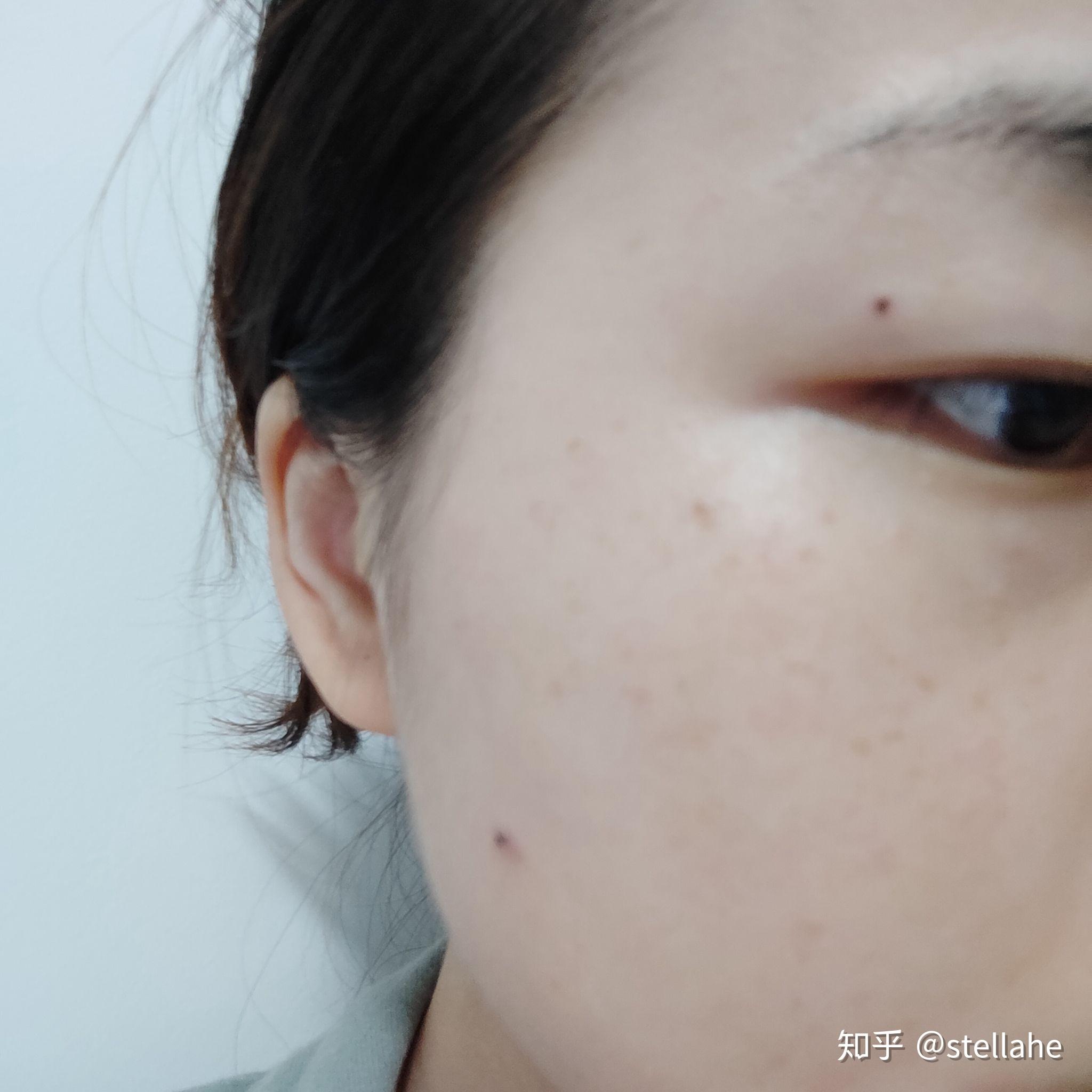 北京点痣医院——专业痣疗服务引领者