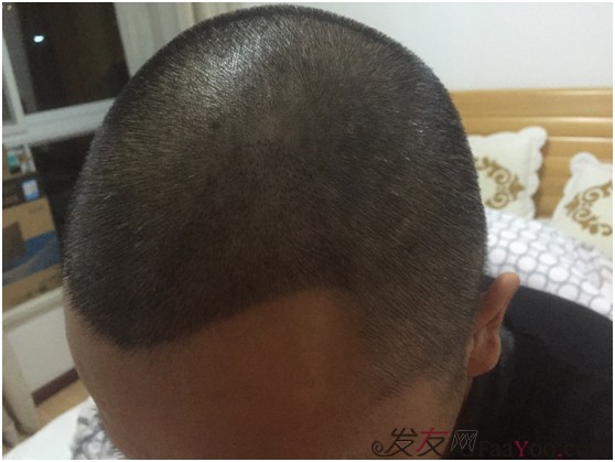 广州植发价格，全面解析与深度探讨