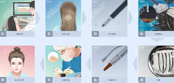 碧莲盛植发技术，探索植发成本与费用