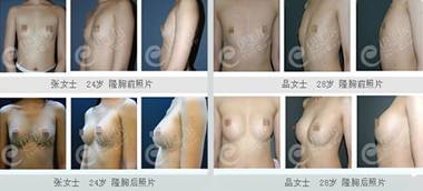 寻找最佳假体隆胸医院，专业、安全、效果的完美结合