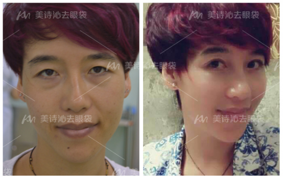 北京专业眼袋去除术，寻找最佳的医疗场所与专家团队