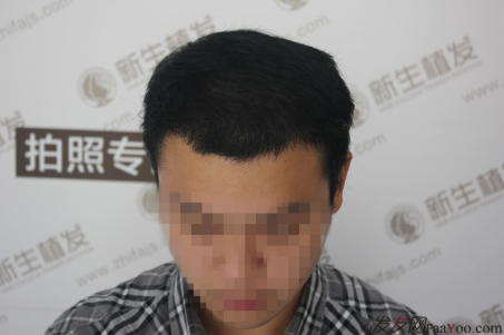 南京植发，重塑自信，焕发新生