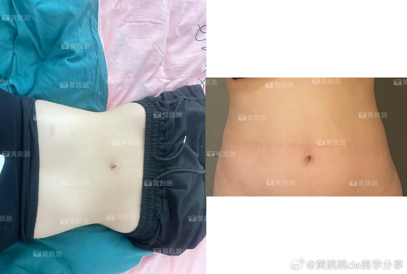 西安抽脂减肥，重塑自信，追寻美丽新篇章