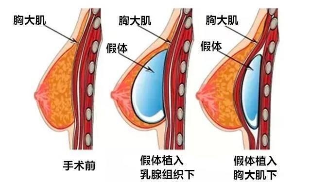 整形医院展示隆胸效果的独特魅力与重要性
