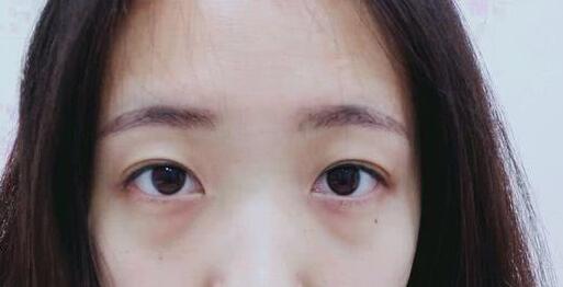 北京去眼袋哪里效果最好？全面解析您的选择