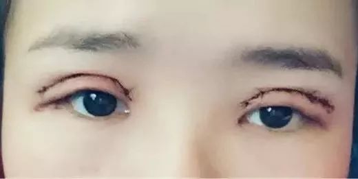 青岛伊美尔双眼皮——塑造自然美丽的秘密武器