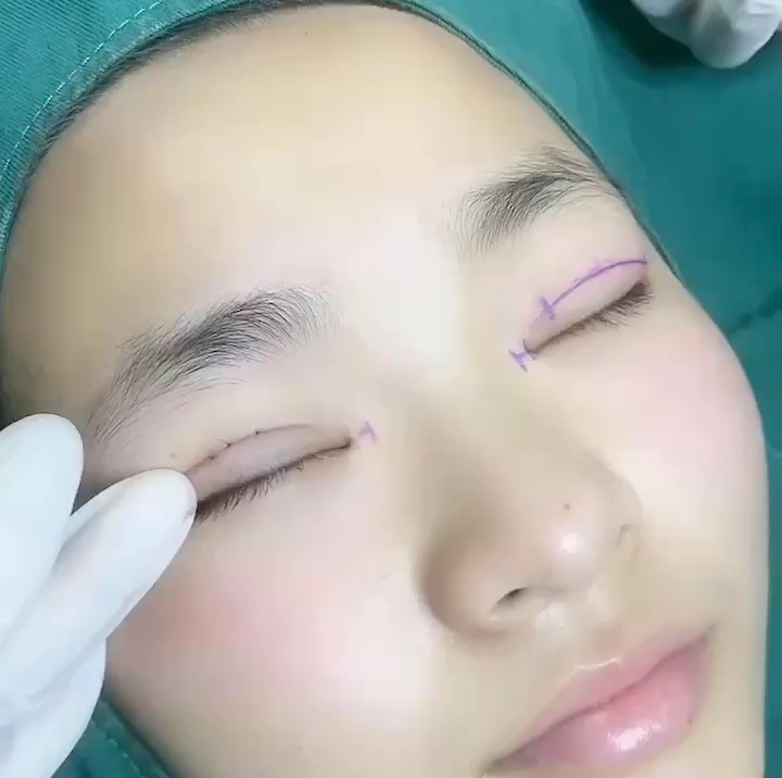 华美双眼皮，塑造迷人眼神的秘密武器