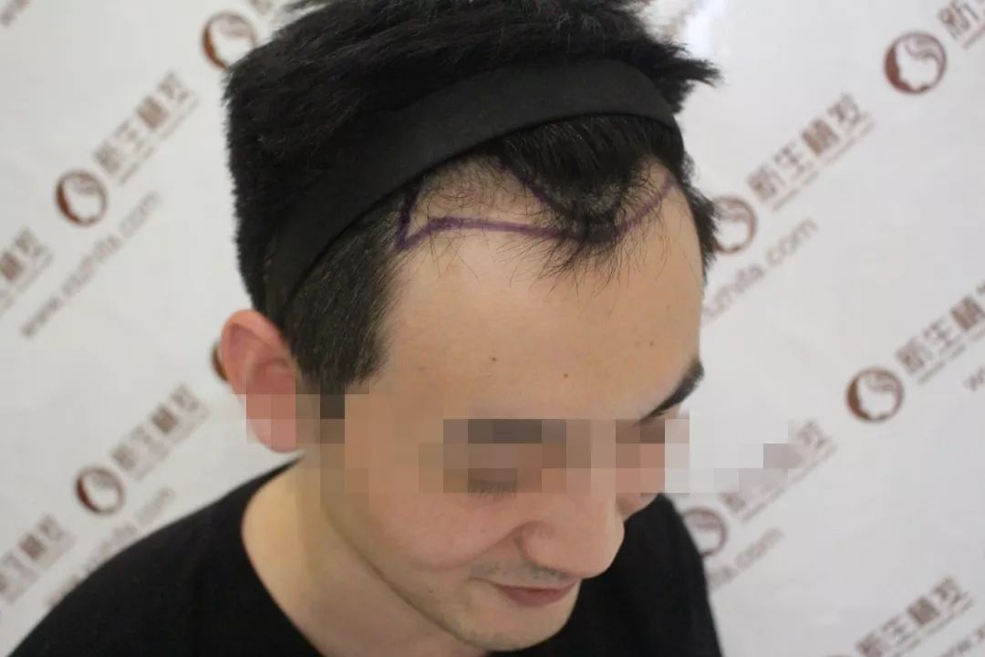 种植头发医院，重塑自信的全新起点