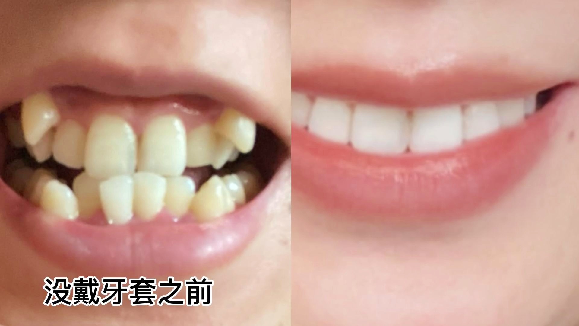 杭州牙齿矫正，重塑自信的微笑