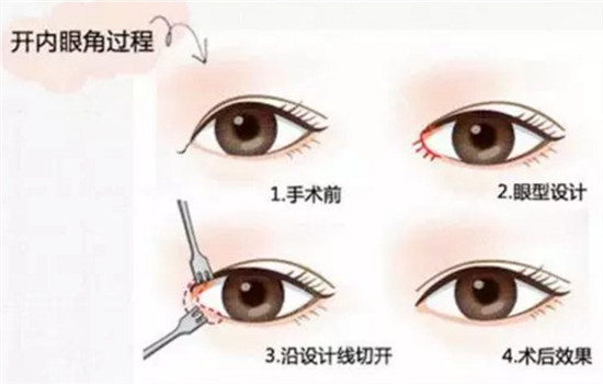 开内眼角手术，探寻最佳地点与策略