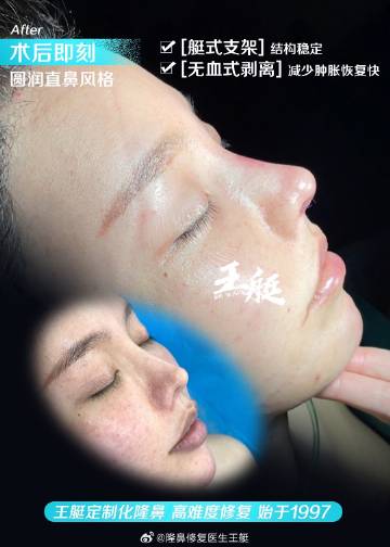 王艇隆鼻，重塑美丽的艺术之旅