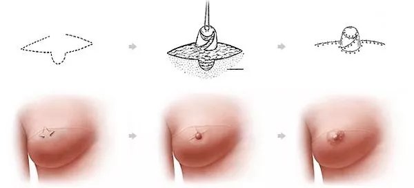 北京乳房再造，重塑女性自信与美丽