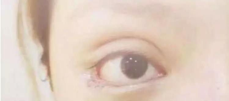 北京开外眼角，重塑美丽双眼的艺术手术