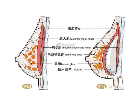 丰胸，探寻最佳途径的选择