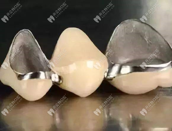 上海钴铬烤瓷牙价格详解