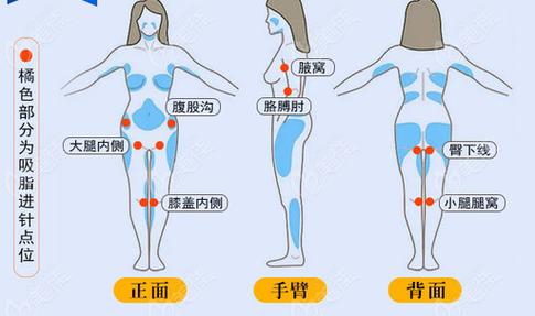 上海吸脂减肥价格详解