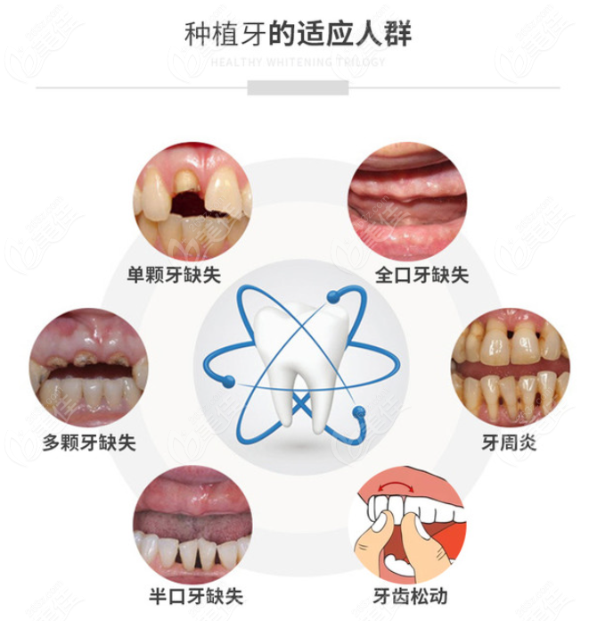 广州种牙费用解析，多少钱一颗？2023年最新行情