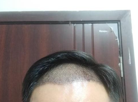 植发哪家好的全面解析，专业团队与个性化方案的完美结合