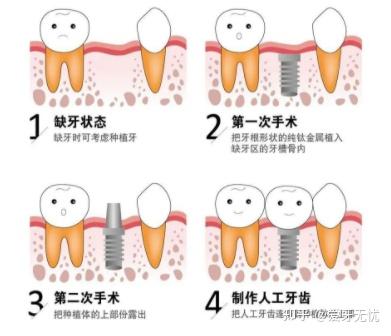 北京种植牙价格解析