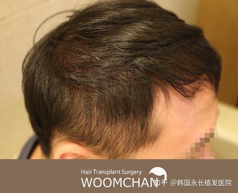毛发种植，探寻最佳的毛发种植地点