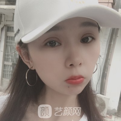 开眼角手术，预约张冰洁，让美丽从眼开始