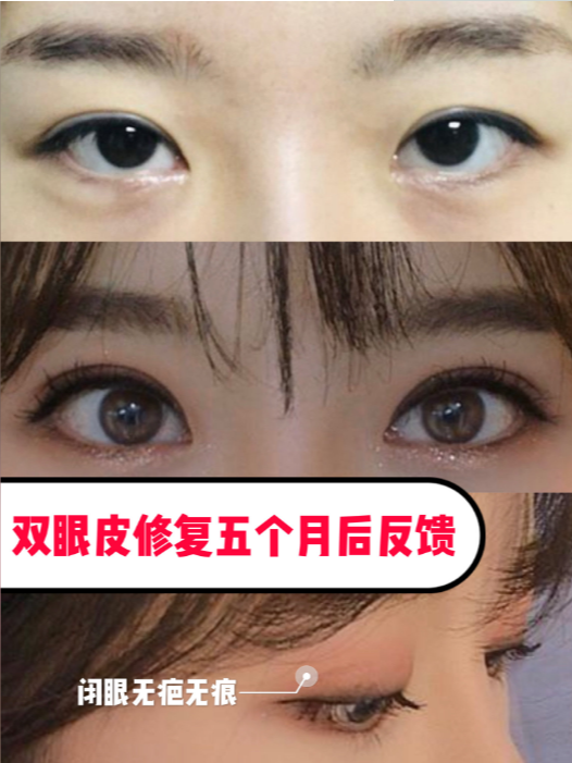 双眼皮的优势与选择，何处是最佳之选？