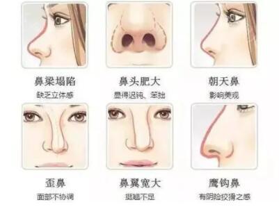 朝天鼻矫正需要多少钱？全面解析费用因素与注意事项