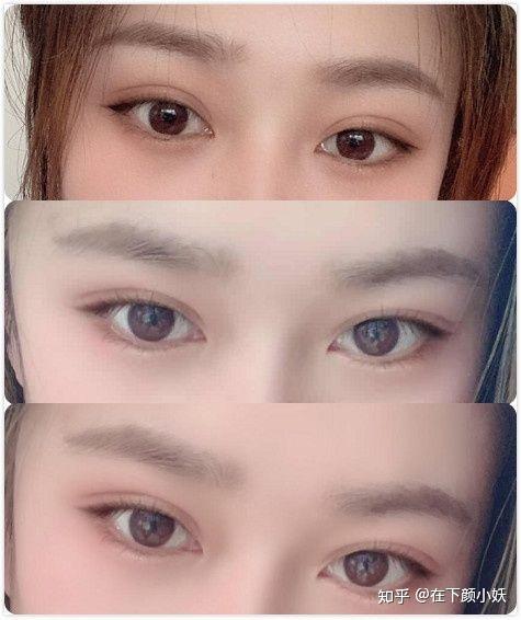 双眼皮手术